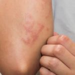 Fungal Infections: ఫంగల్ ఇన్ఫెక్షన్లు తగ్గాలంటే ? ఈ టిప్స్ ట్రై చేయండి