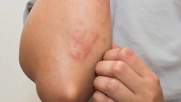 Fungal Infections: ఫంగల్ ఇన్ఫెక్షన్లు తగ్గాలంటే ? ఈ టిప్స్ ట్రై చేయండి