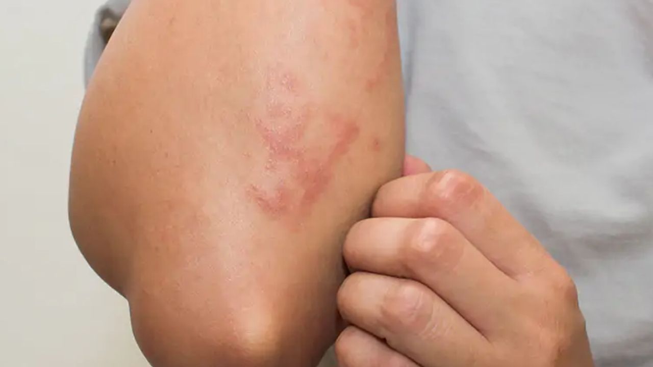 Fungal Infections: ఫంగల్ ఇన్ఫెక్షన్లు తగ్గాలంటే ? ఈ టిప్స్ ట్రై చేయండి