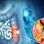 Colon Cancer: ఈ లక్షణాలను అస్సలు నిర్లక్ష్యం చేయొద్దు. కోలన్ క్యాన్సర్ కావచ్చు !