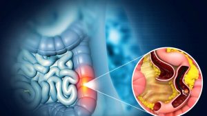 Colon Cancer: ఈ లక్షణాలను అస్సలు నిర్లక్ష్యం చేయొద్దు. కోలన్ క్యాన్సర్ కావచ్చు !