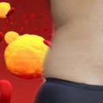 Cholesterol: శరీరంలో కొలెస్ట్రాల్ పెరిగినప్పుడు.. ఎలాంటి లక్షణాలు కనిపిస్తాయ్ !