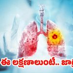 Lung Cancer: ఊపిరితిత్తుల క్యాన్సర్.. చాలా మంది నిర్లక్ష్యం చేసే లక్షణాలివే !