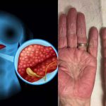 Liver Disease: ఈ లక్షణాలు మీలో ఉన్నాయా ? అయితే లివర్ పాడైనట్లే !