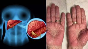 Liver Disease: ఈ లక్షణాలు మీలో ఉన్నాయా ? అయితే లివర్ పాడైనట్లే !