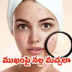 Black Spots On Face: ముఖంపై నల్ల మచ్చలా ? ఇలా చేస్తే.. బెస్ట్ రిజల్ట్స్