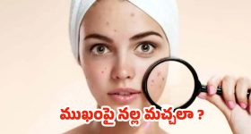 Black Spots On Face: ముఖంపై నల్ల మచ్చలా ? ఇలా చేస్తే.. బెస్ట్ రిజల్ట్స్