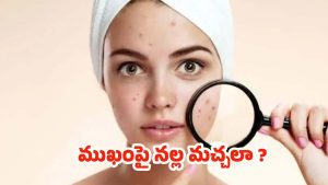 Black Spots On Face: ముఖంపై నల్ల మచ్చలా ? ఇలా చేస్తే.. బెస్ట్ రిజల్ట్స్
