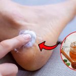 Cracked Heels:పగిలిన మడమలకు చక్కటి పరిష్కారం.. వీటితో అద్భుతమైన రిజల్ట్