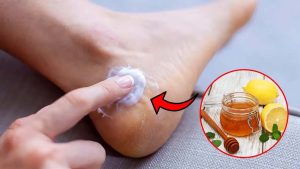 Cracked Heels:పగిలిన మడమలకు చక్కటి పరిష్కారం.. వీటితో అద్భుతమైన రిజల్ట్
