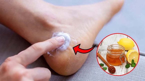 Cracked Heels:పగిలిన మడమలకు చక్కటి పరిష్కారం.. వీటితో అద్భుతమైన రిజల్ట్