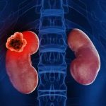 Kidney Damage: కిడ్నీలను నిశ్శబ్దంగా దెబ్బతీసే.. 7 అలవాట్లు