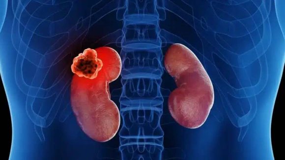 Kidney Damage: కిడ్నీలను నిశ్శబ్దంగా దెబ్బతీసే.. 7 అలవాట్లు Kidney Damage: కిడ్నీలను నిశ్శబ్దంగా దెబ్బతీసే.. 7 అలవాట్లు