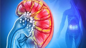 Kidney Stones: కిడ్నీ స్టోన్స్ సమస్యా ? పొరపాటున కూడా ఇవి తినొద్దు !