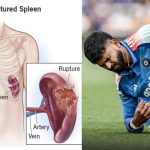 Shreyas Iyer ICU: డేంజ‌ర్‌లో శ్రేయాస్ అయ్యర్… అస‌లు గాయం ఎక్క‌డ అయిందంటే