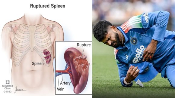 Shreyas Iyer ICU: డేంజర్లో శ్రేయాస్ అయ్యర్… అసలు గాయం ఎక్కడ అయిందంటే Shreyas Iyer ICU: డేంజర్లో శ్రేయాస్ అయ్యర్… అసలు గాయం ఎక్కడ అయిందంటే