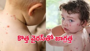 Tomato virus: పిల్లల్లో టమాటా వైరస్.. ఇది ఎలా వ్యాప్తి చెందుతోంది? లక్షణాలేమిటీ?