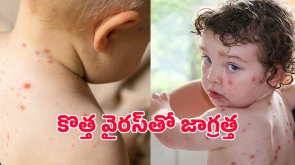 Tomato virus: పిల్లల్లో టమాటా వైరస్.. ఇది ఎలా వ్యాప్తి చెందుతోంది? లక్షణాలేమిటీ?