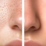 Open Pores On Face: ఓపెన్ ఫోర్స్ తగ్గాలంటే..ఈ సింపుల్ చిట్కాలు ట్రై చేయండి