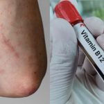 Vitamin B12 Deficiency:  మీలో ఈ లక్షణాలున్నాయా ?  అస్సలు నిర్లక్ష్యం చేయొద్దు !