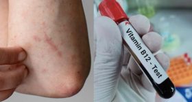 Vitamin B12 Deficiency:  మీలో ఈ లక్షణాలున్నాయా ?  అస్సలు నిర్లక్ష్యం చేయొద్దు !