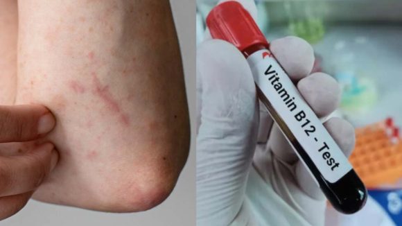 Vitamin B12 Deficiency:  మీలో ఈ లక్షణాలున్నాయా ?  అస్సలు నిర్లక్ష్యం చేయొద్దు !