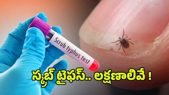 Scrub Typhus Cases: ఏపీలోని ఈ జిల్లాల్లో విజృంభిస్తున్న స్క్రబ్ టైఫస్.. వామ్మో ఇంత ప్రమాదమా?