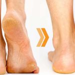 Cracked Heels: మడమల పగుళ్లకు అసలు కారణాలు తెలిస్తే.. షాక్ అవుతారు