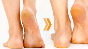 Cracked Heels: మడమల పగుళ్లకు అసలు కారణాలు తెలిస్తే.. షాక్ అవుతారు