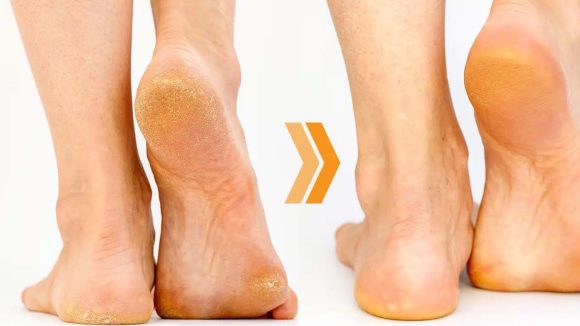 Cracked Heels: మడమల పగుళ్లకు అసలు కారణాలు తెలిస్తే.. షాక్ అవుతారు