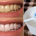 Teeth Whitening: ఎనామిల్‌ను దెబ్బతీయకుండా.. పళ్లు తెల్లగా మెరిసిపోవాలంటే ?