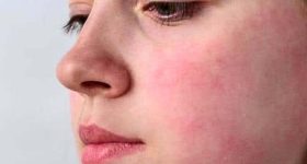 Fatty Liver: బ్యూటీ స్పాట్ కాదు, డేంజర్ స్పాట్ ! ఫ్యాటీ లివర్ ముదిరితే ముఖంపై వచ్చే 7 లక్షణాలు..