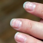 High cholesterol Symptoms: మీ గోళ్లు ఇలా ఉన్నాయా ? అయితే శరీరంలో హై కొలెస్ట్రాల్ ఉన్నట్లే !