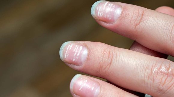 High cholesterol Symptoms: మీ గోళ్లు ఇలా ఉన్నాయా ? అయితే శరీరంలో హై కొలెస్ట్రాల్ ఉన్నట్లే !