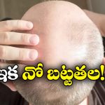 Baldness: బట్టతల బాబులకు గుడ్ న్యూస్, ఇక హ్యాపీగా వెంట్రుకలు మొలిపించుకోవచ్చు!
