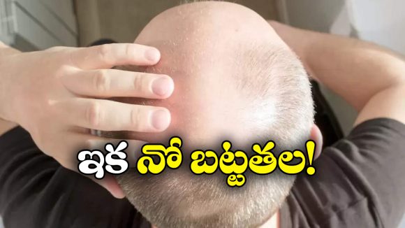 Baldness: బట్టతల బాబులకు గుడ్ న్యూస్, ఇక హ్యాపీగా వెంట్రుకలు మొలిపించుకోవచ్చు!