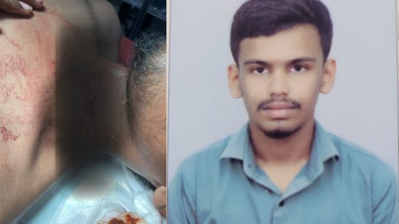 Keesara Kite String Injury: సంక్రాంతి సంబరమా.. మృత్యు పాశమా? చైనా మాంజా ధాటికి యువకుడికి 19 కుట్లు! కీసరలో విషాదం