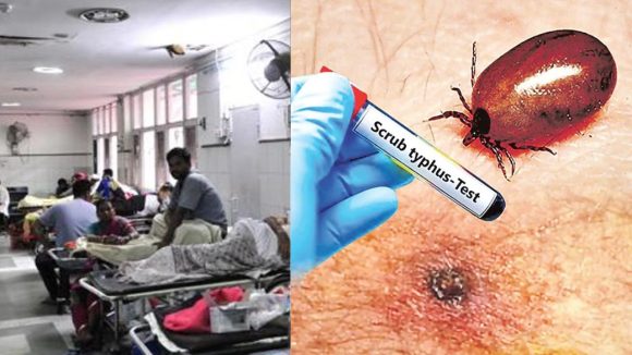 Scrub Typhus Cases: ఏపీలో వణికిస్తున్న స్క్రబ్ టైఫ‌స్ కేసులు..  అన్ని జిల్లాల్లో నమోదు, డాక్టర్లు ఏమంటున్నారు?