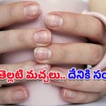 White Spots On Nails: చేతివేళ్ల గోర్లపై తెల్లటి మచ్చలు ఏర్పడ్డయా?.. ఈ రోగాలకు సంకేతం కావొచ్చంటున్న వైద్యులు!