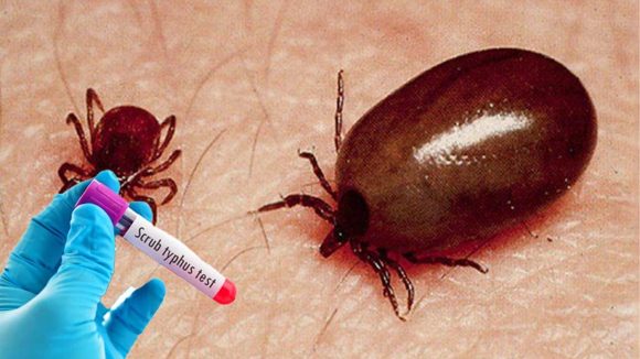 Scrub Typhus: రాష్ట్రంలో స్క్రబ్ టైఫస్ కలకలం.. పెరుగుతున్న మరణాల సంఖ్య!