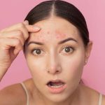 How to cure acne: ఏవేవో క్రీములు వాడాల్సిన అవసరమే లేదు.. వీటితో క్షణాల్లోనే మొటిమలు మాయం