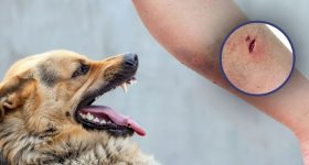 Dog Bite: కుక్క కరిచిన వెంటనే.. ఏం చేయాలో తెలుసా ?