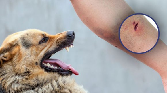 Dog Bite: కుక్క కరిచిన వెంటనే.. ఏం చేయాలో తెలుసా ?