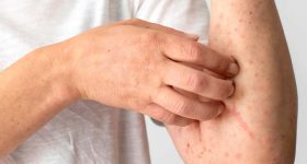 Fatty Liver Signs: మీ కాలేయం ఆరోగ్యంగా ఉందో లేదో మీ చేతులే చెప్తాయ్.. ఈ 5 లక్షణాలు చెక్ చేసుకోండి