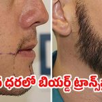Beard Transplant: మ్యాన్లీ లుక్ కోసం బియర్డ్ ట్రాన్స్‌ప్లాంట్ చేయించుకుంటున్నారా? ఈ విషయాలు తప్పక తెలుసుకోండి