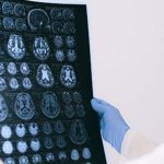 Stroke Risk: స్ట్రోక్ లక్షణాలను ముందే గుర్తించడం ఎలా? ఈ చిట్కాలతో ప్రాణాలను కాపాడొచ్చు !