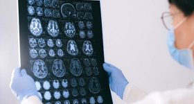 Stroke Risk: స్ట్రోక్ లక్షణాలను ముందే గుర్తించడం ఎలా? ఈ చిట్కాలతో ప్రాణాలను కాపాడొచ్చు !