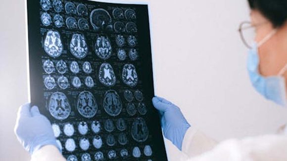 Stroke Risk: స్ట్రోక్ లక్షణాలను ముందే గుర్తించడం ఎలా? ఈ చిట్కాలతో ప్రాణాలను కాపాడొచ్చు !