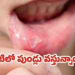 Mouth Ulcers: నోటిలో పుండ్ల సమస్యలకు చెక్.. ఇవి వాడితే క్షణాల్లోనే ప్రాబ్లమ్ సాల్వ్