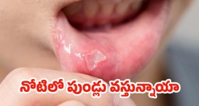 Mouth Ulcers: నోటిలో పుండ్ల సమస్యలకు చెక్.. ఇవి వాడితే క్షణాల్లోనే ప్రాబ్లమ్ సాల్వ్